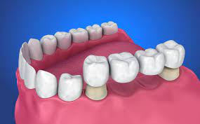 Teeth Prostho