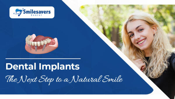 Dental Implants in Sunnyvale