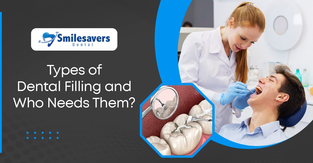 Types of Dental Filling and Who Needs Them?