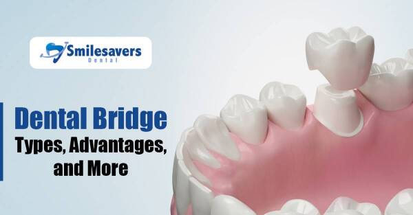 Dental Bridge: Types, Advantages, and More