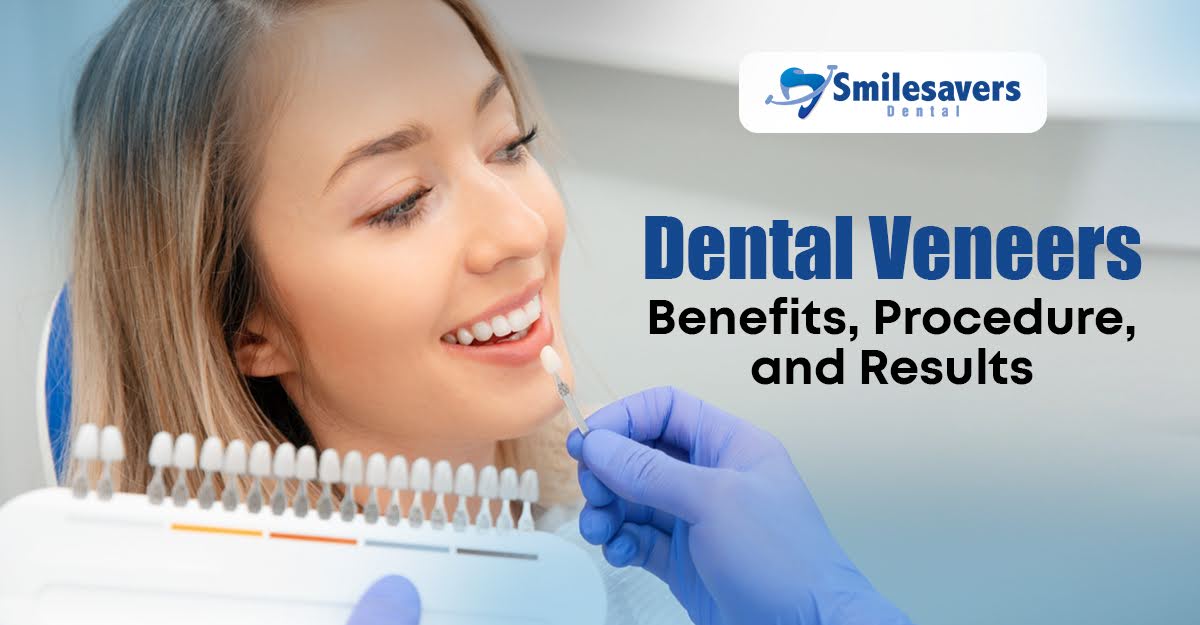 Dental Veneers: Benefits, Procedure, and Results