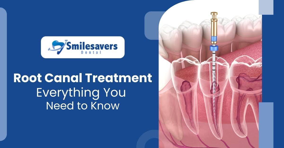 Root Canal Treatment