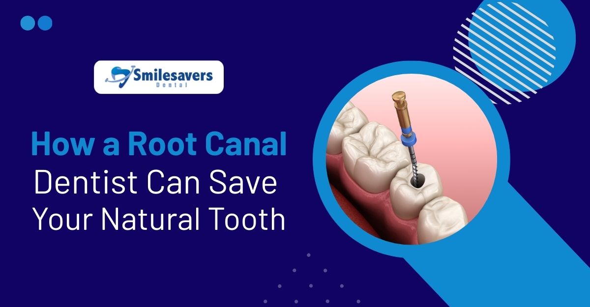 Root Canal Dentist – Save Your Natural Tooth